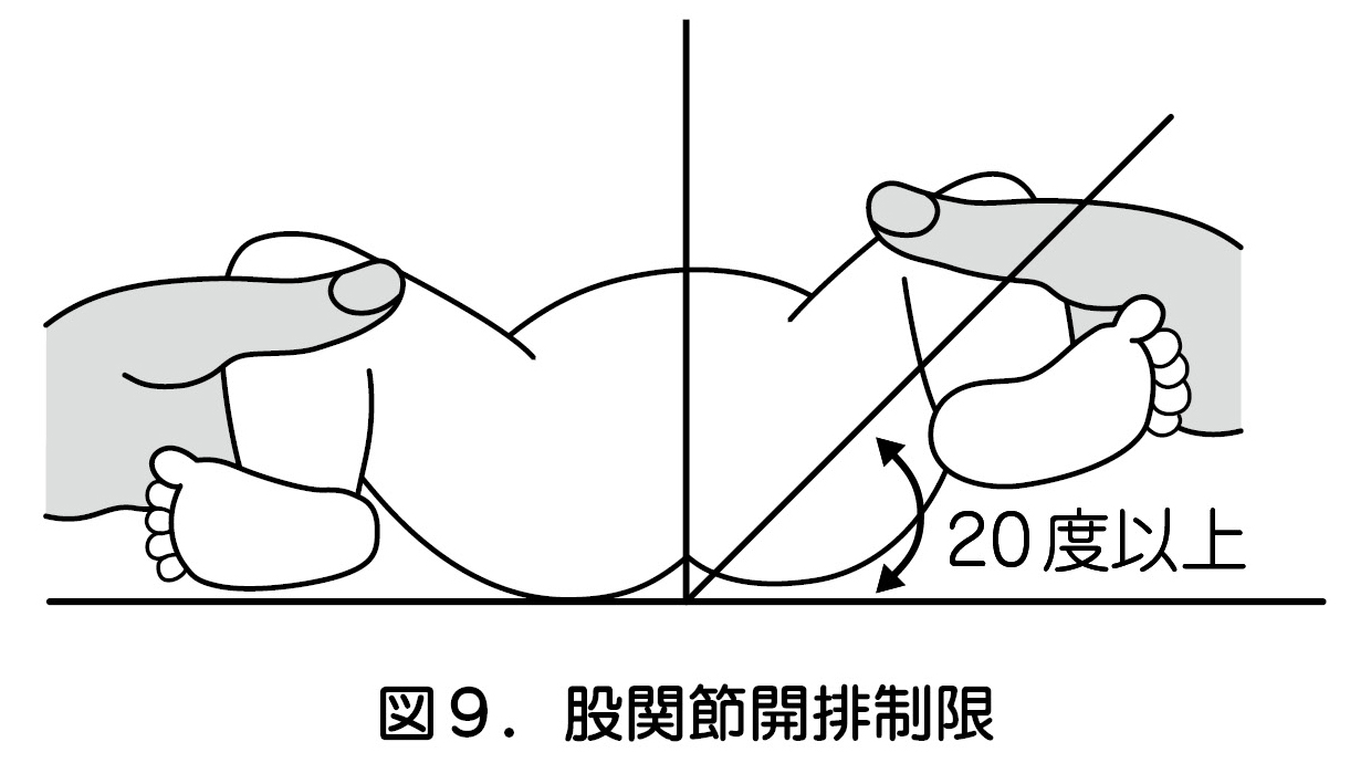 図９．股関節開排制限