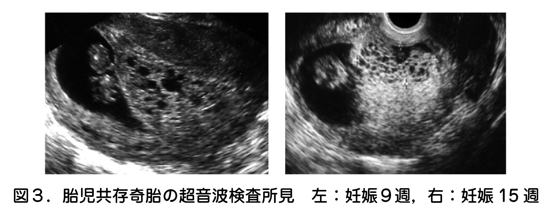 胎児共存奇胎の超音波検査所見　左：妊娠９週，右：妊娠 15 週