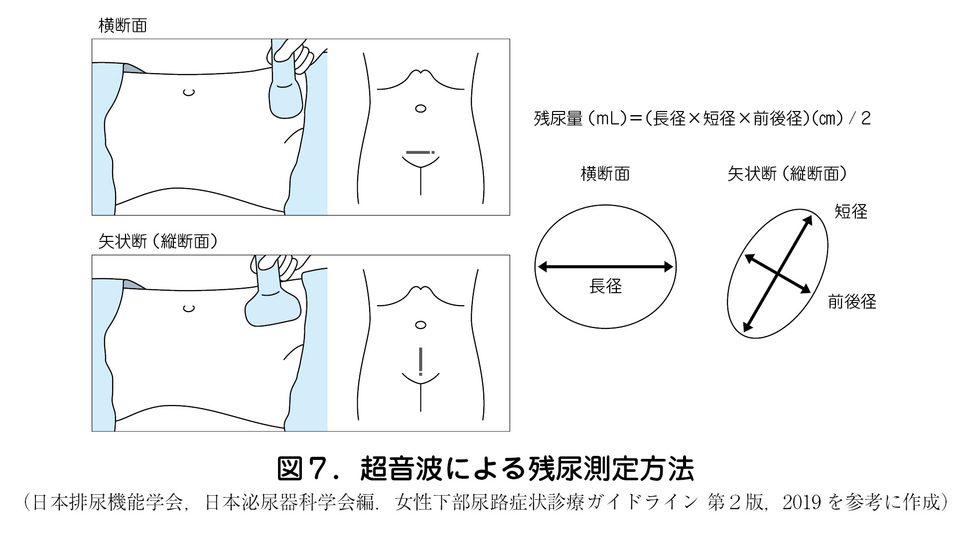 超音波による残尿測定方法