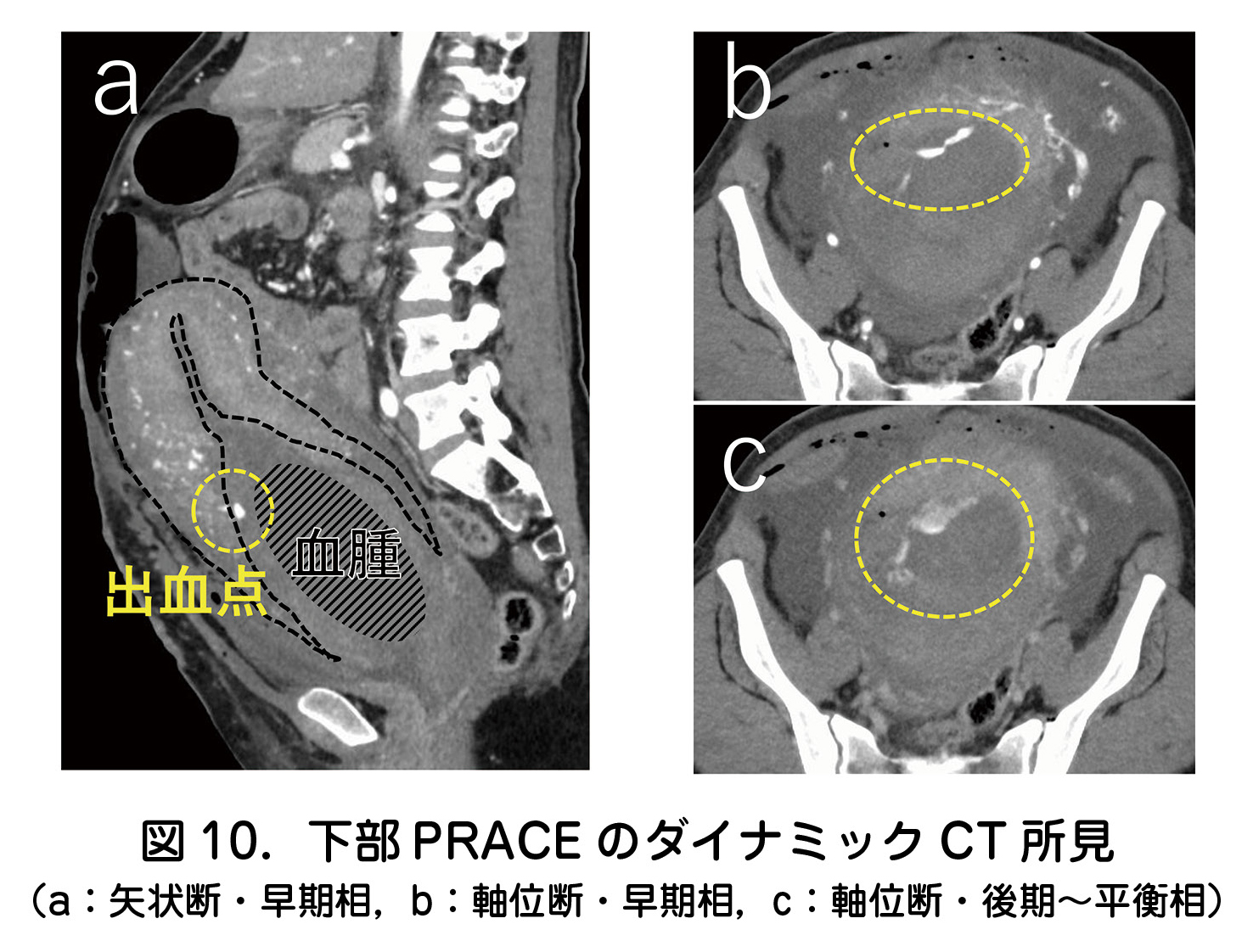 下部 PRACE のダイナミック CT 所見