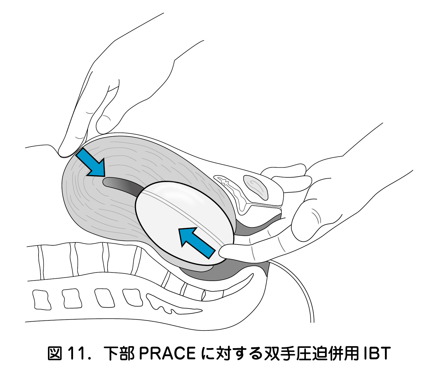 下部 PRACE に対する双手圧迫併用 IBT