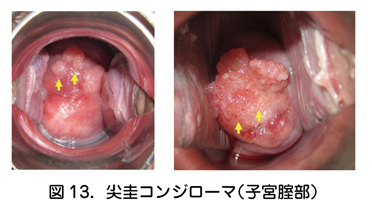 尖圭コンジローマ（子宮腟部）