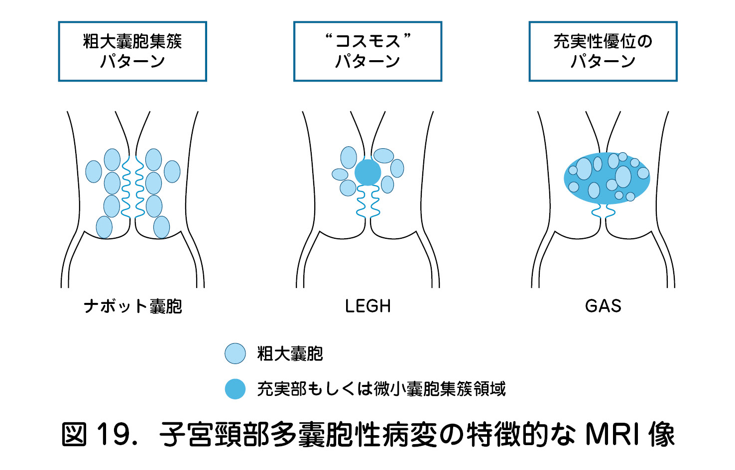 子宮頸部多囊胞性病変の特徴的なMRI像