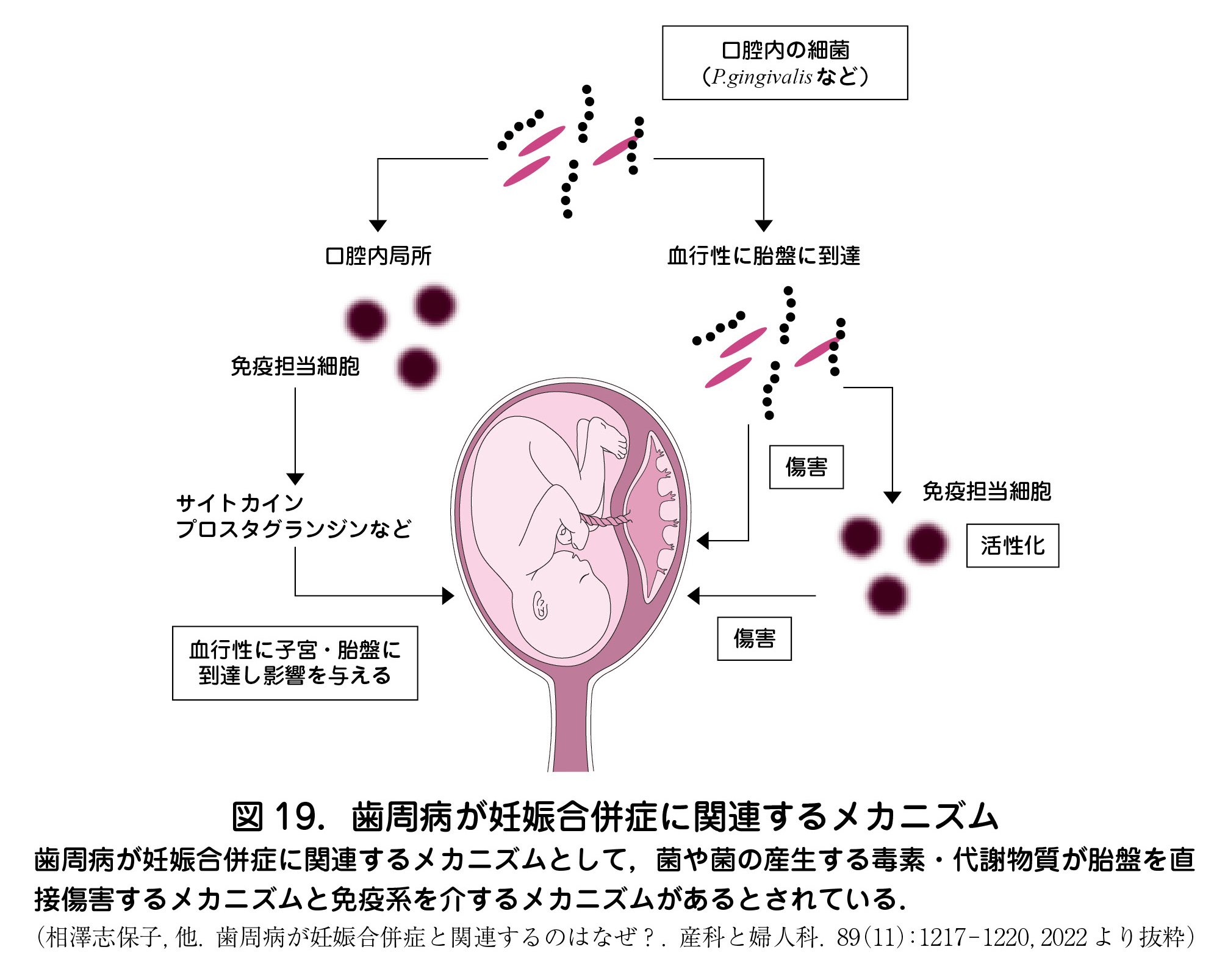 歯周病が妊娠合併症に関連するメカニズム 